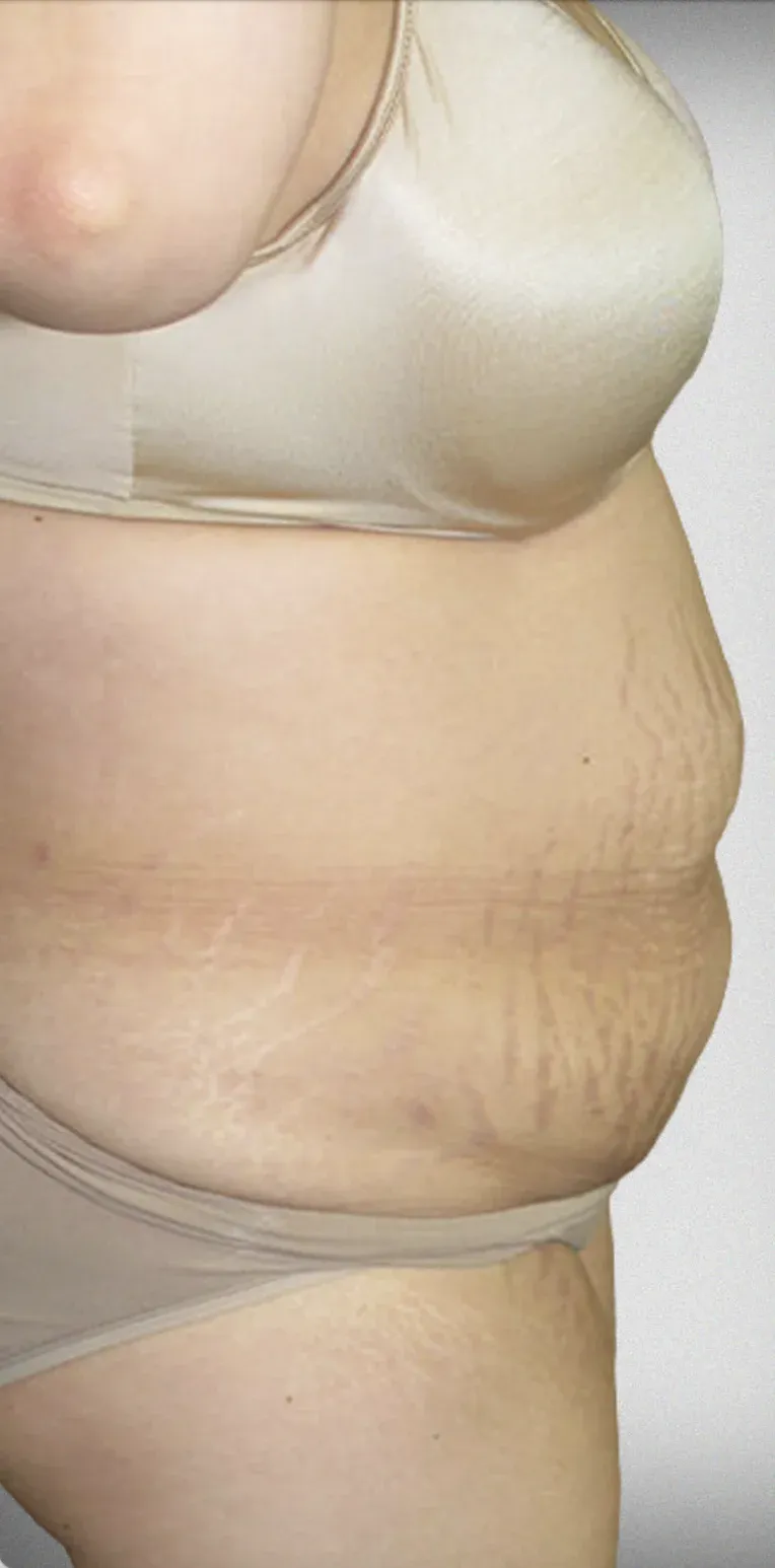 Liposuction7