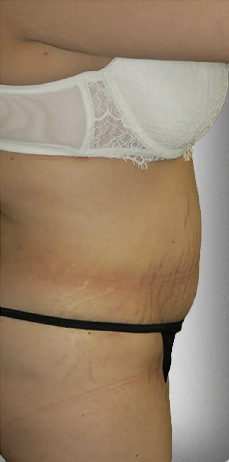 Liposuction8