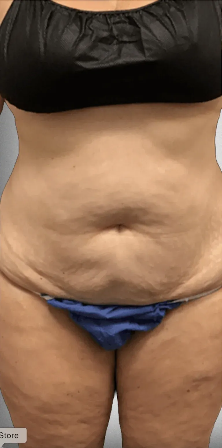 Liposuction9