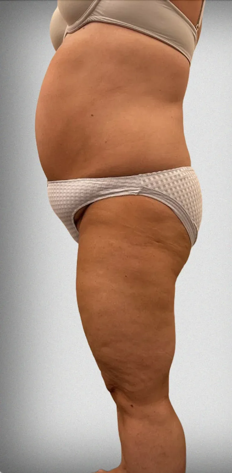 Mega Liposuction