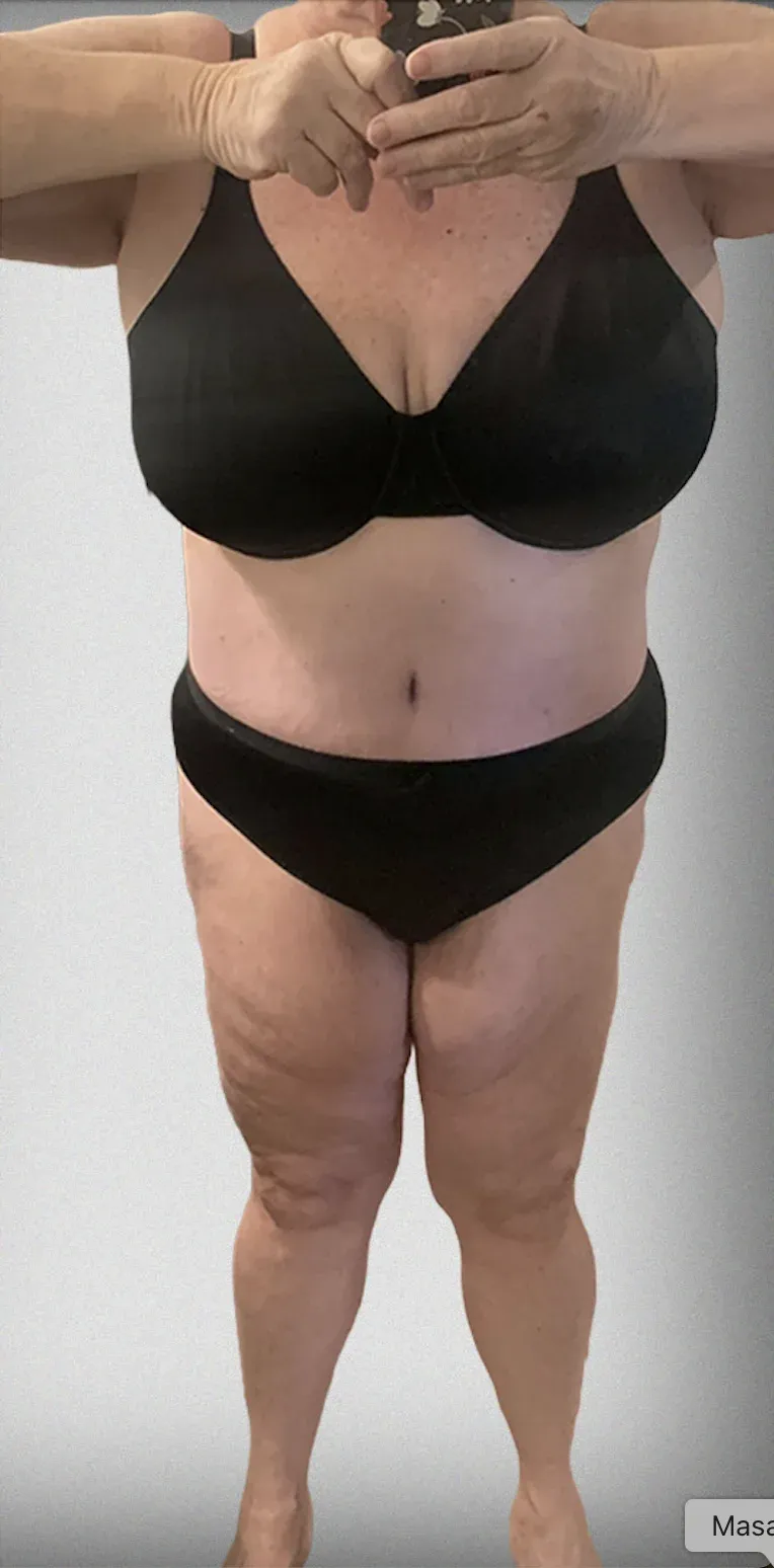 Mega Liposuction10