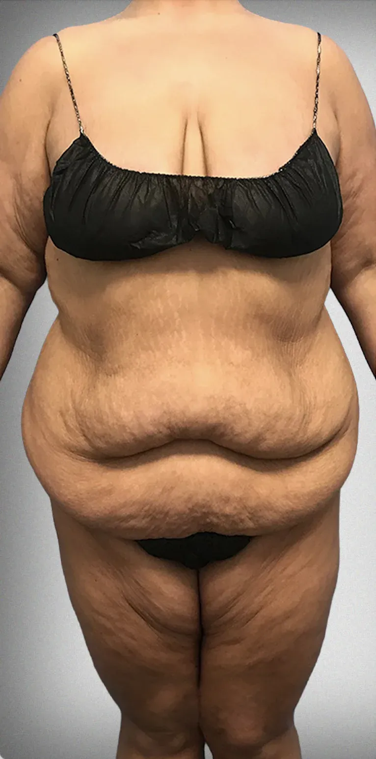 Mega Liposuction11
