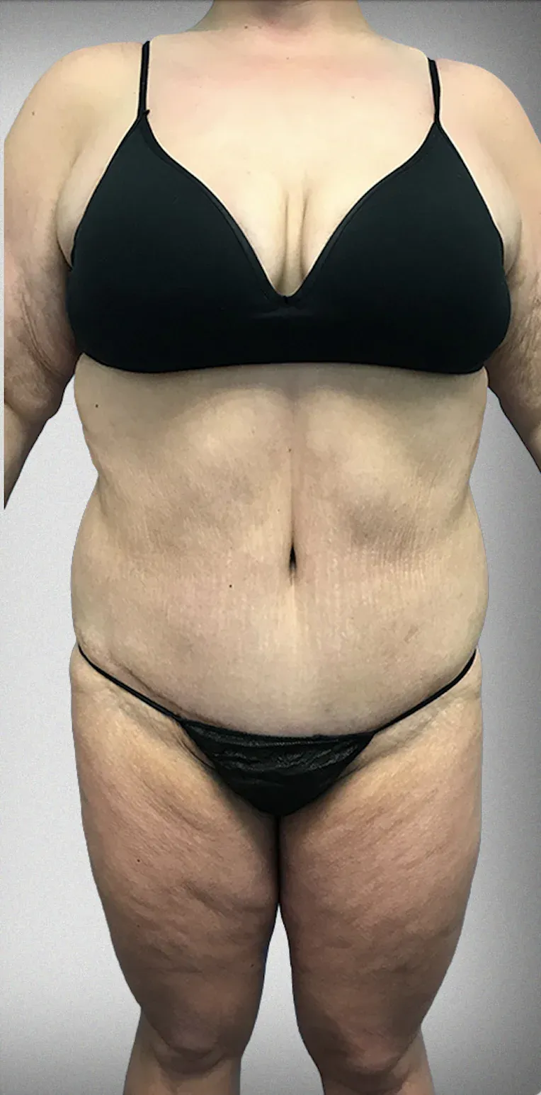 Mega Liposuction12