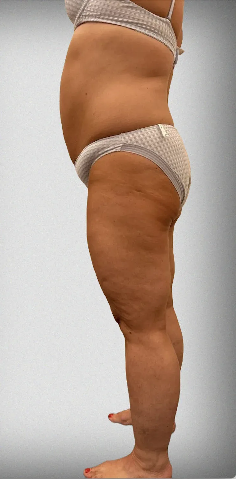 Mega Liposuction2