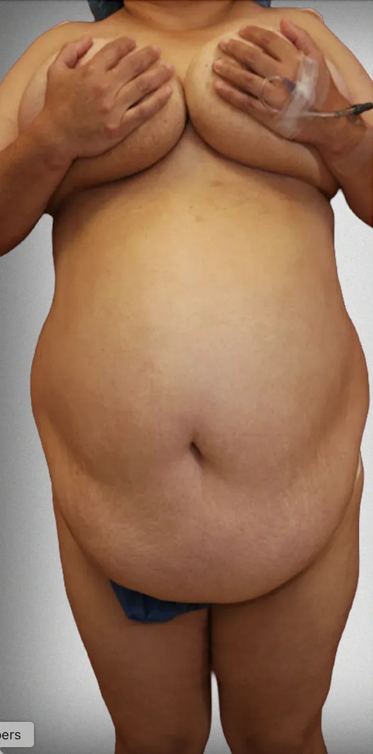 Mega Liposuction3