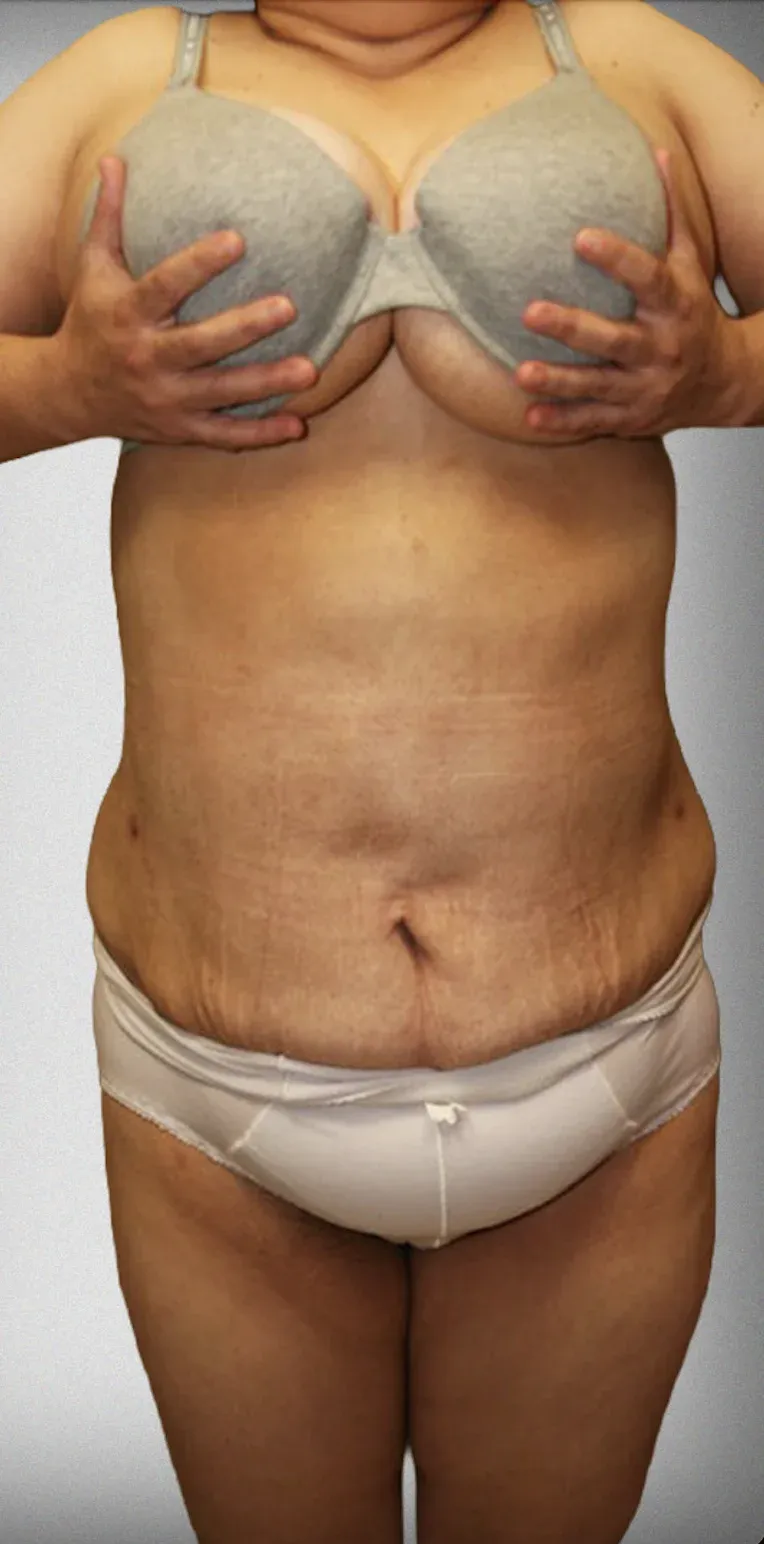 Mega Liposuction4