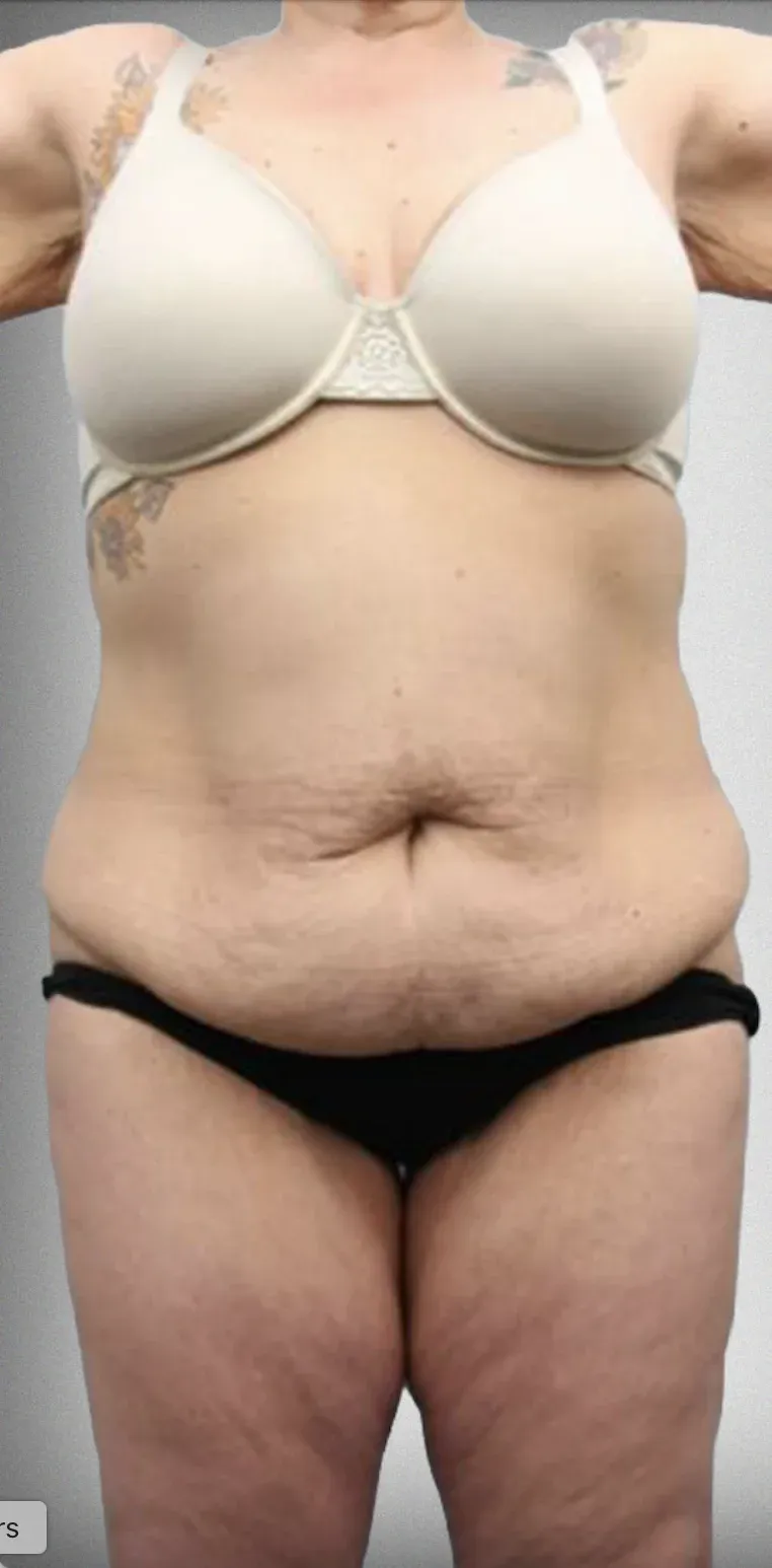 Mega Liposuction5