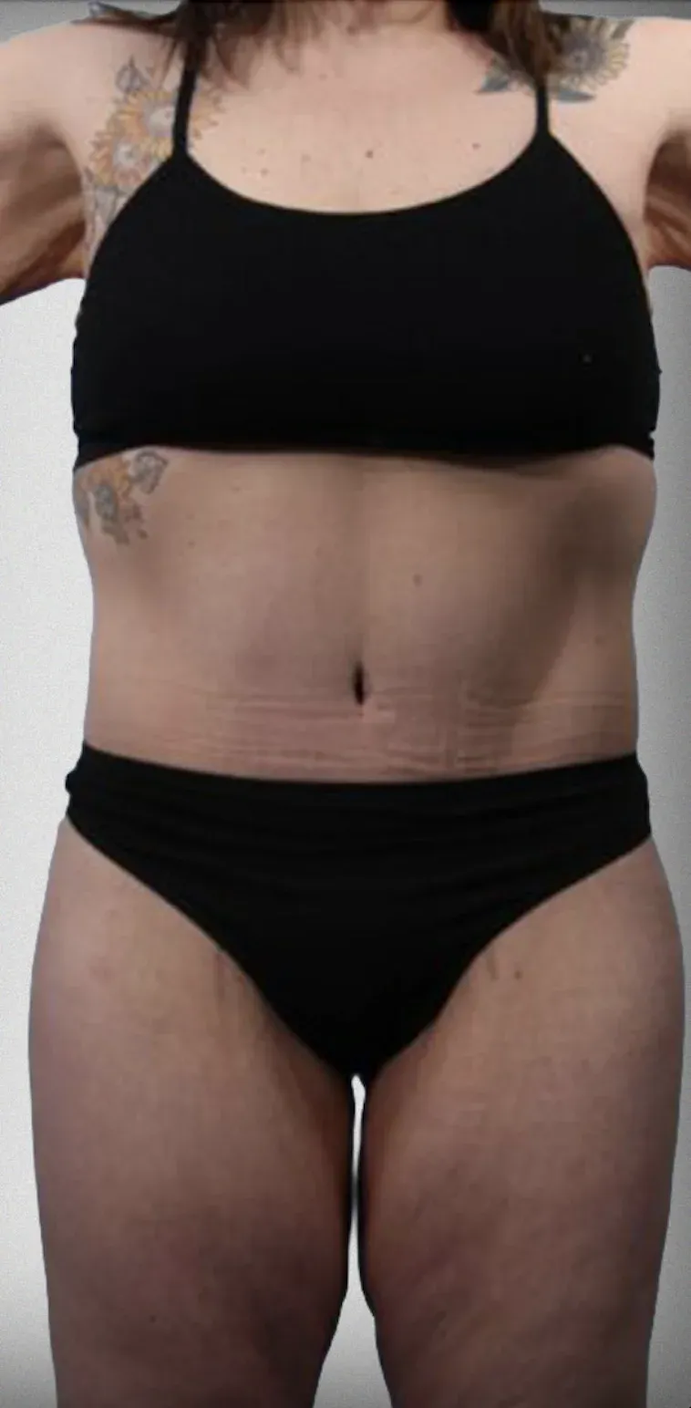 Mega Liposuction6