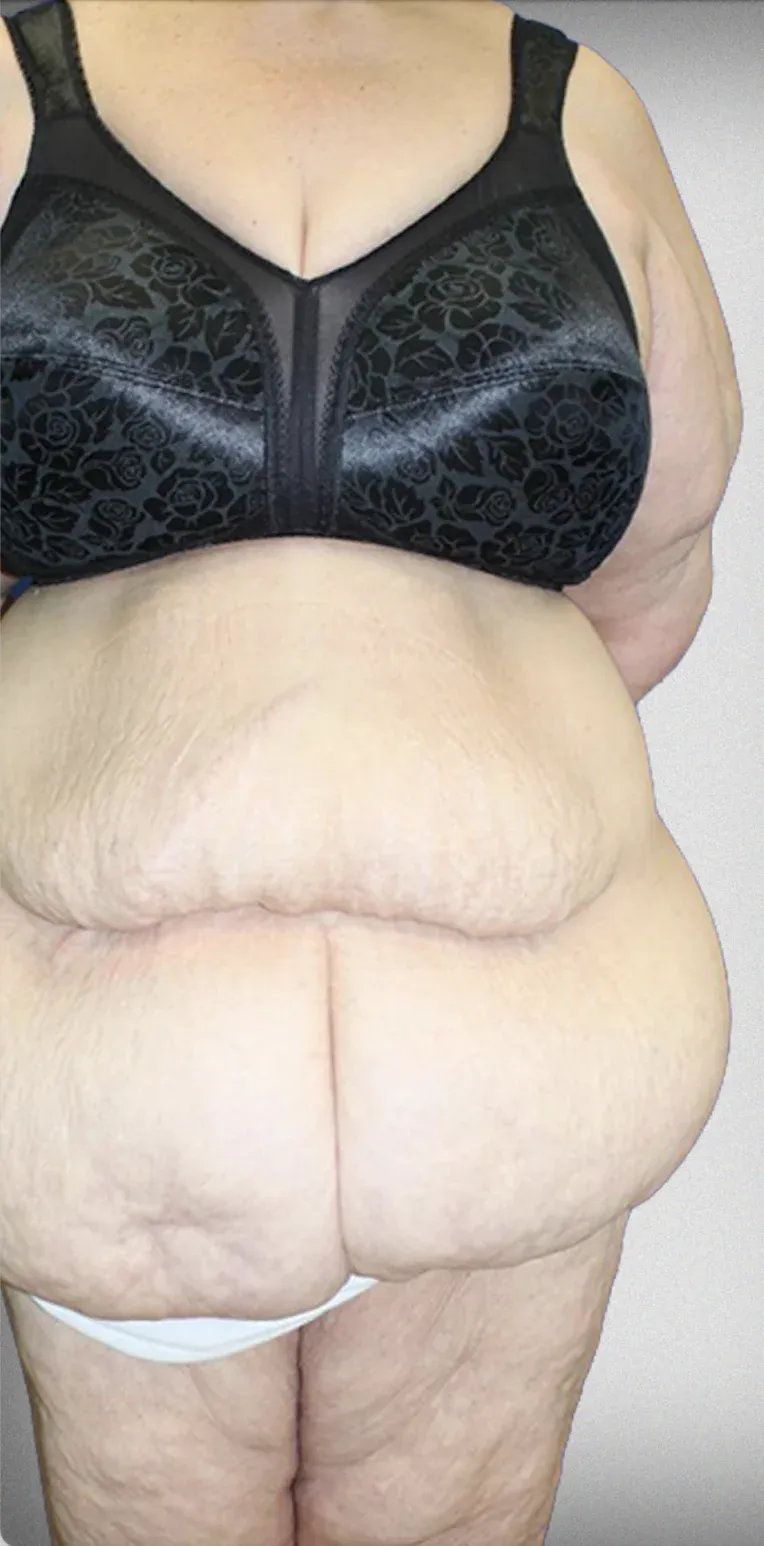 Mega Liposuction7