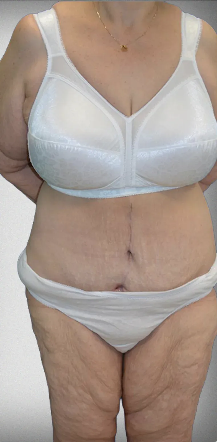 Mega Liposuction8