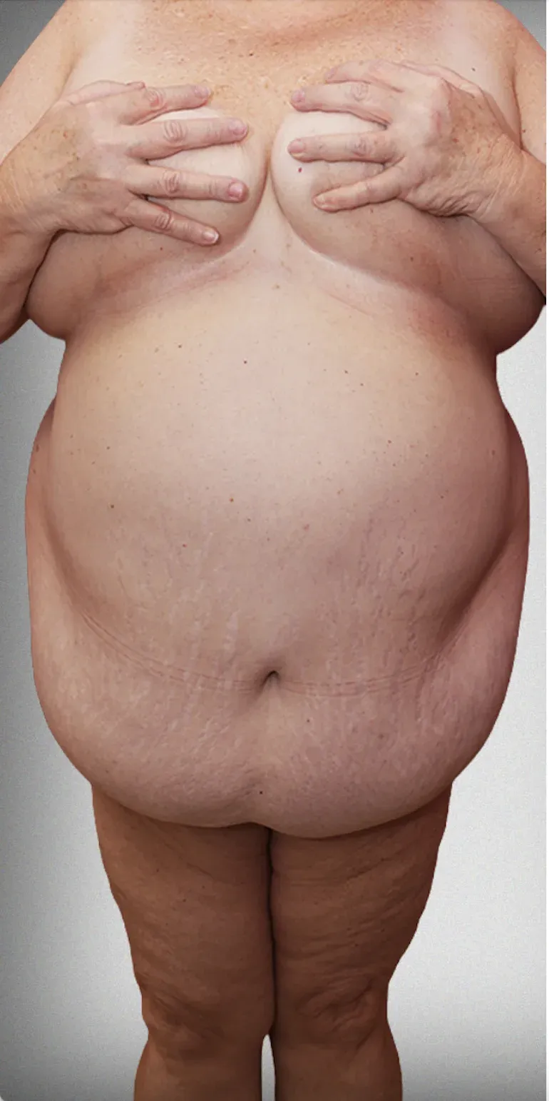 Mega Liposuction9