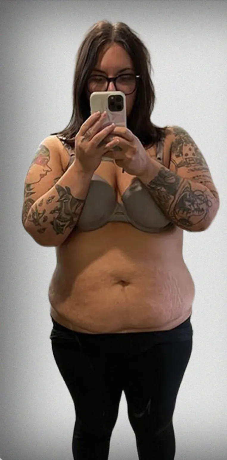 Sleeve Gastrectomy
