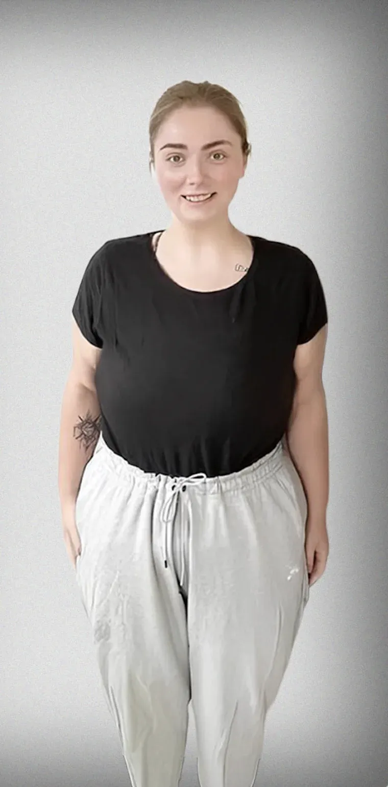 Sleeve Gastrectomy10