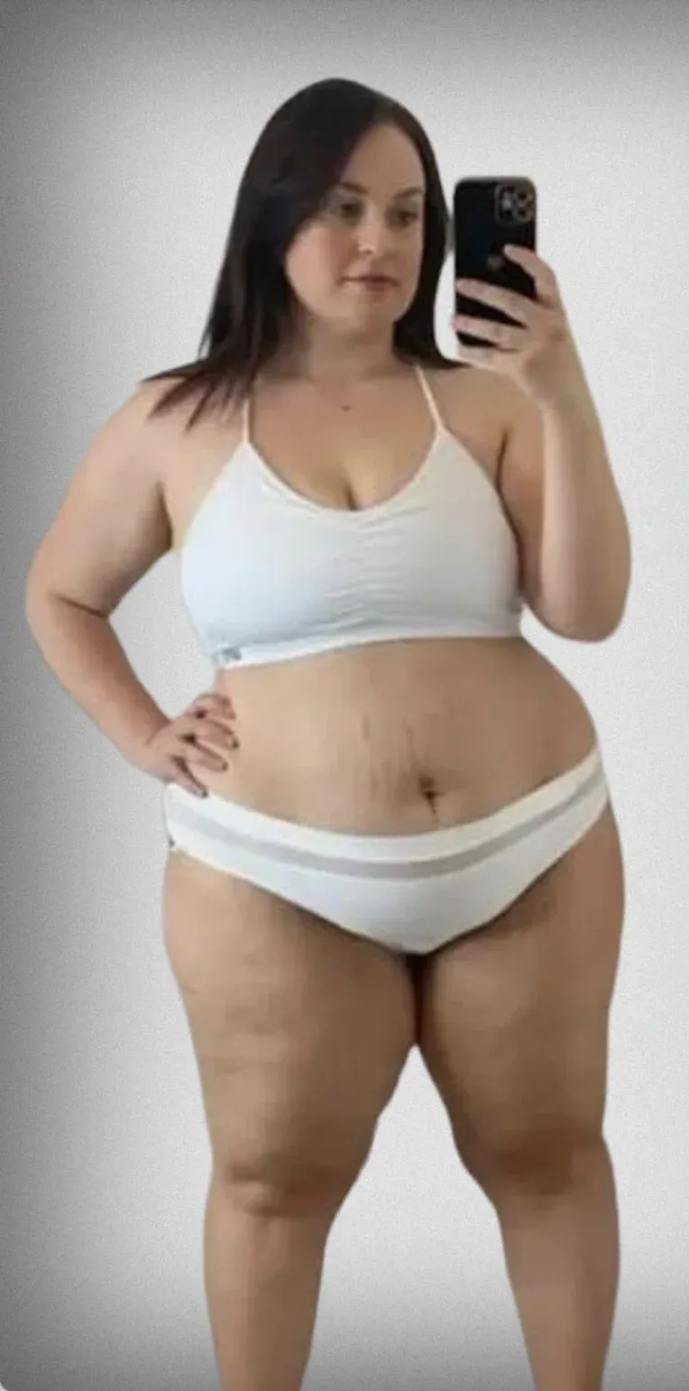 Sleeve Gastrectomy5