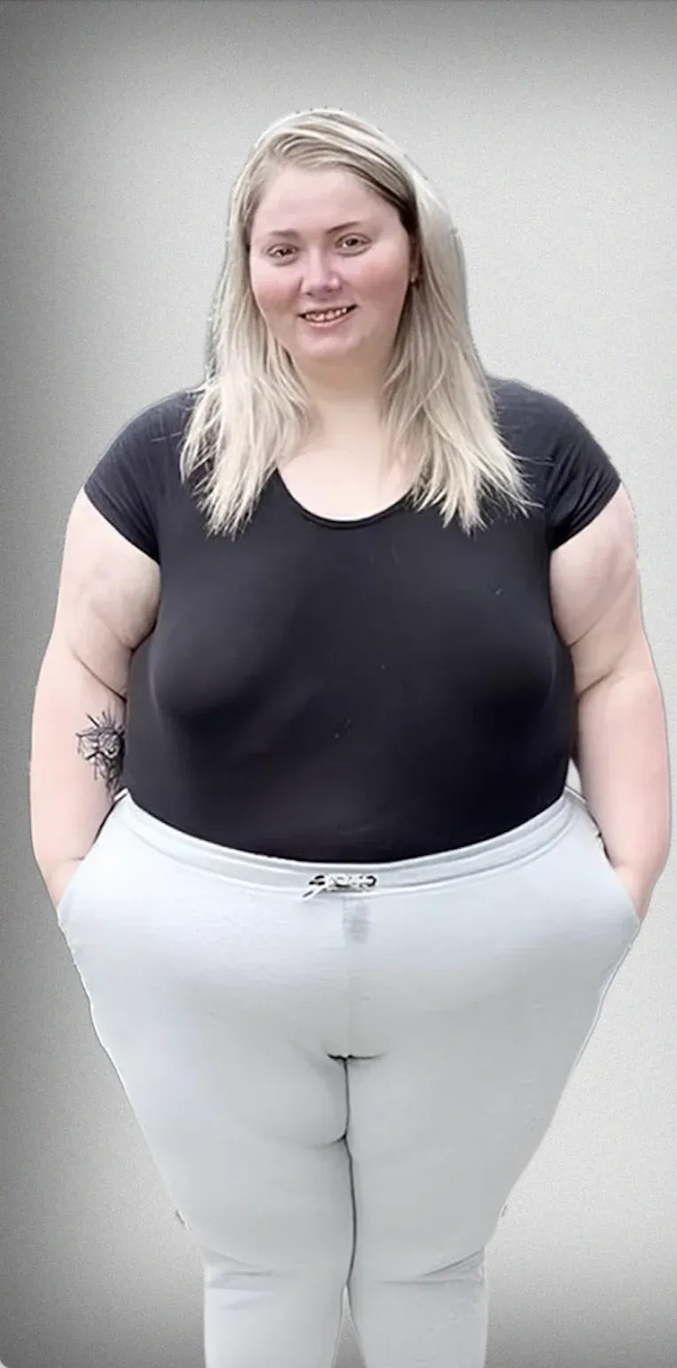Sleeve Gastrectomy9
