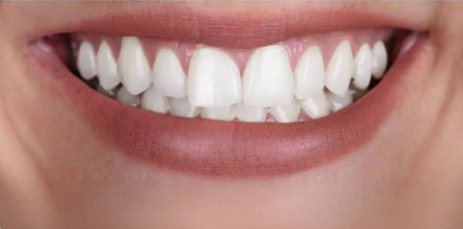 Teeth Whitening before-after10
