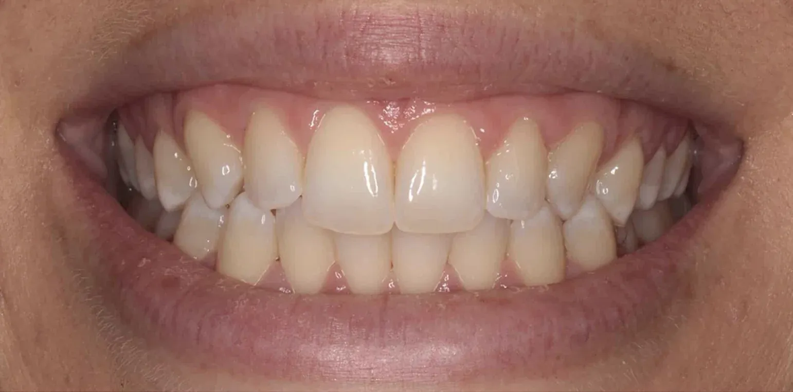 Teeth Whitening before-after11