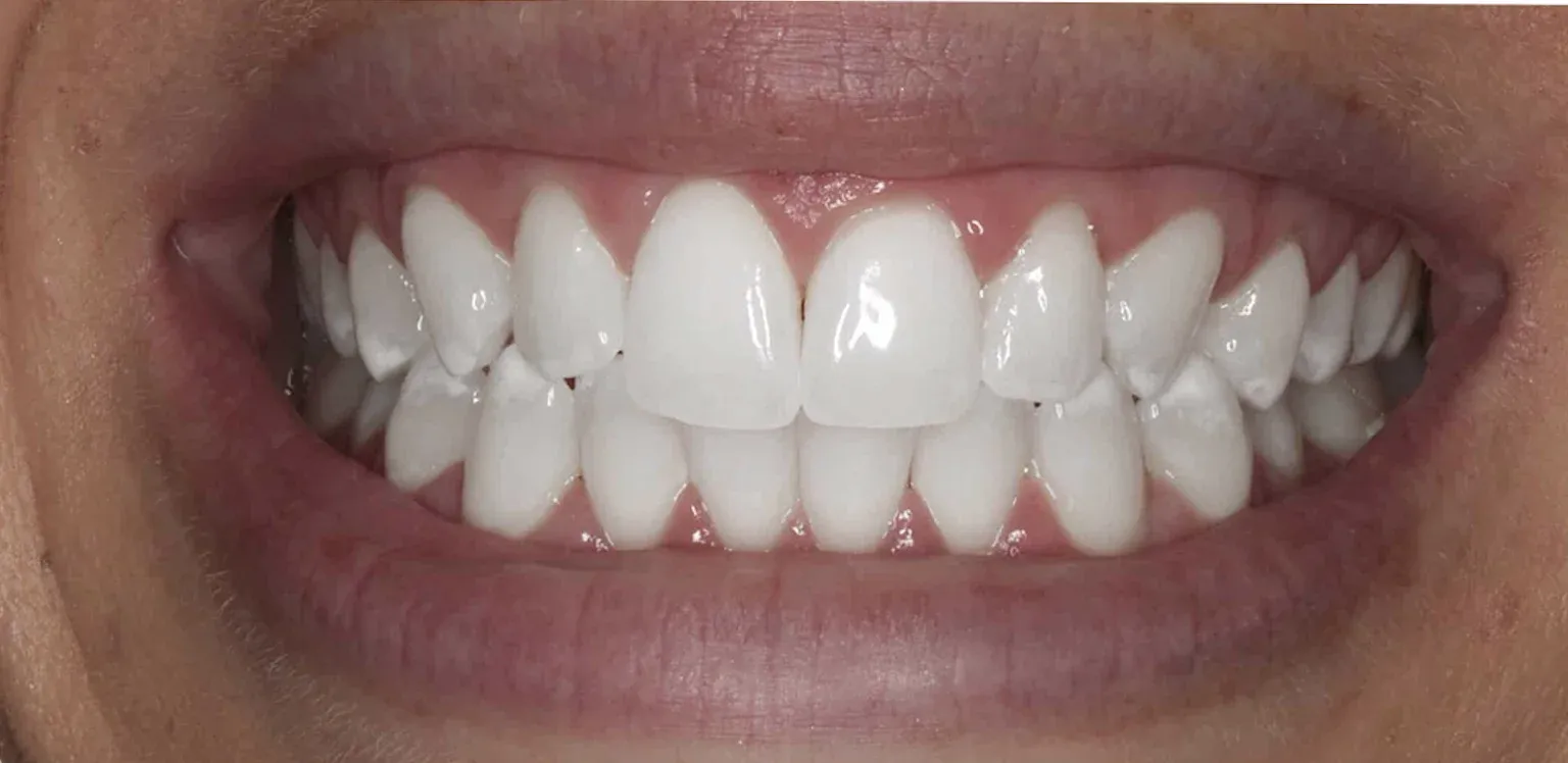 Teeth Whitening before-after12