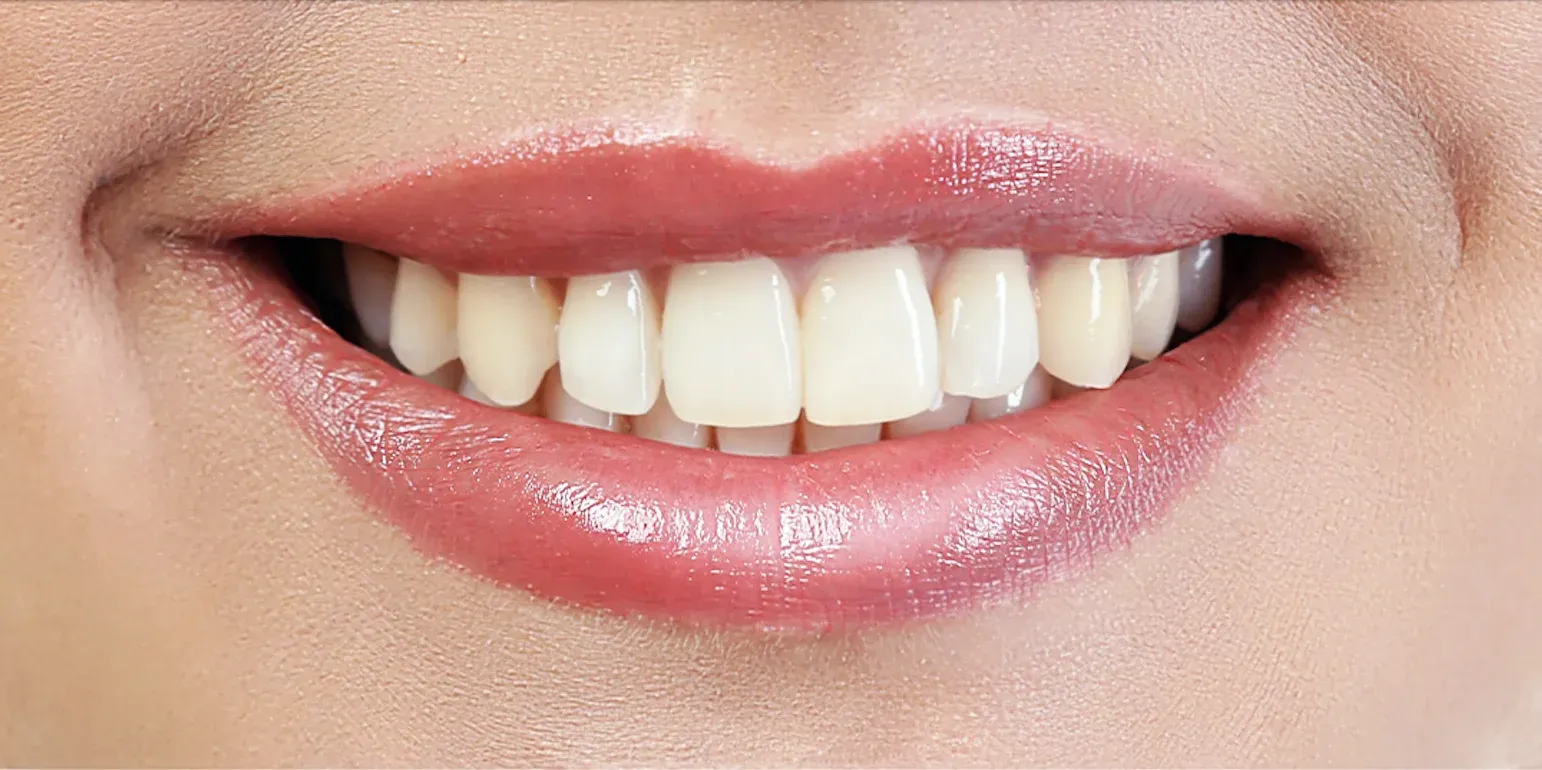 Teeth Whitening before-after3