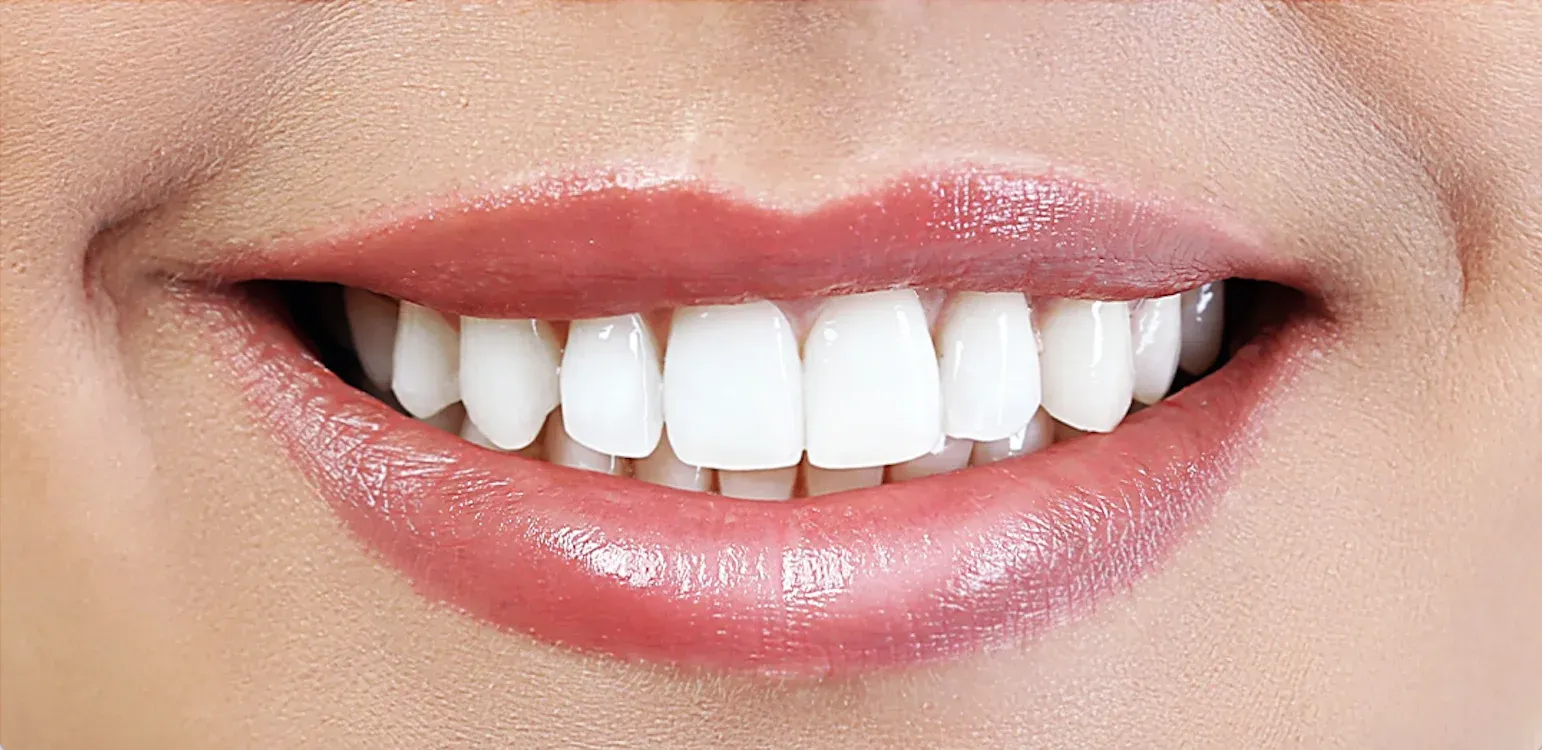 Teeth Whitening before-after4