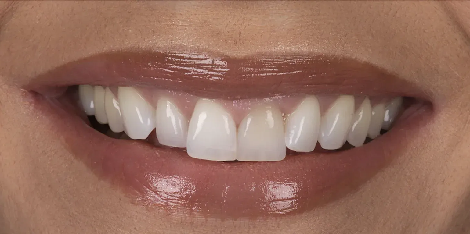 Teeth Whitening before-after5