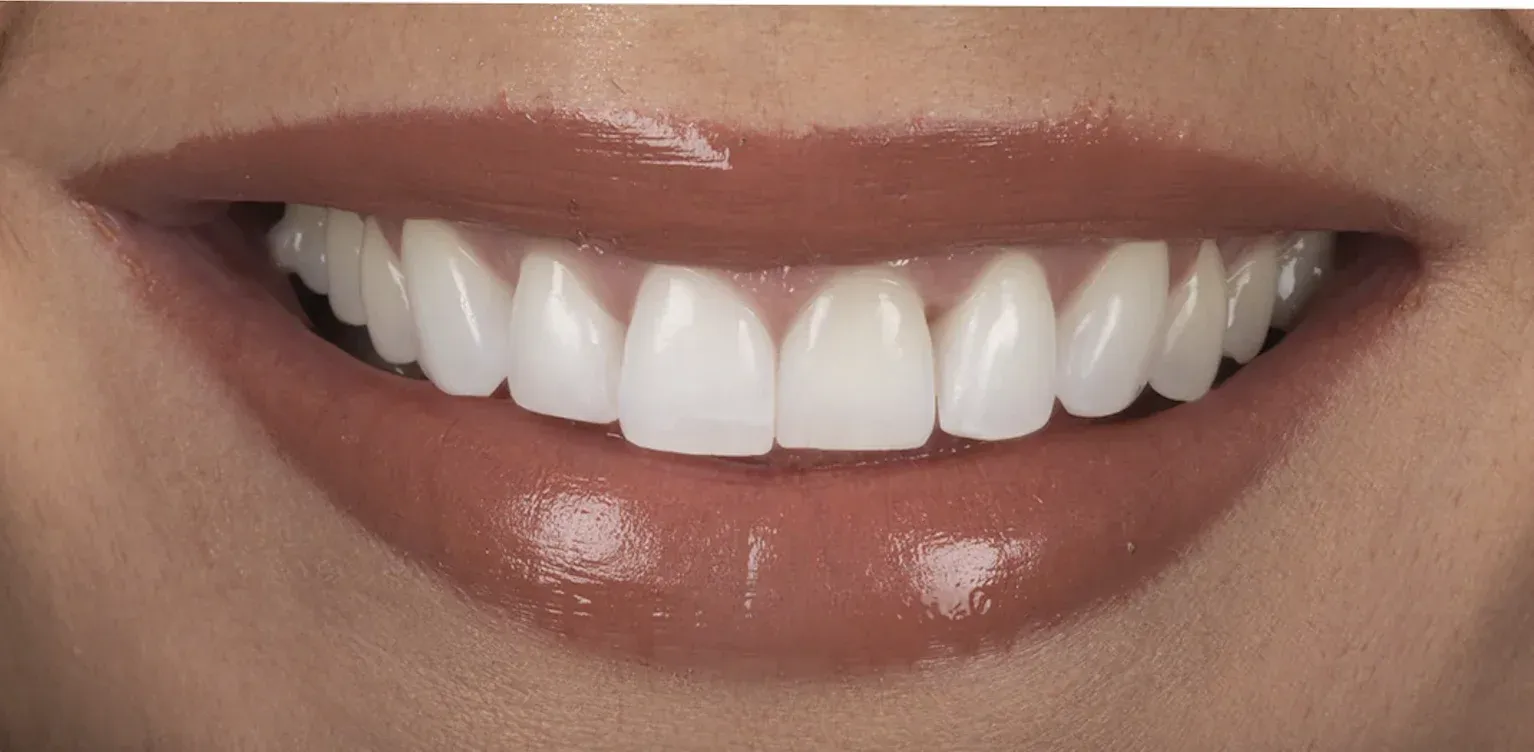 Teeth Whitening before-after6