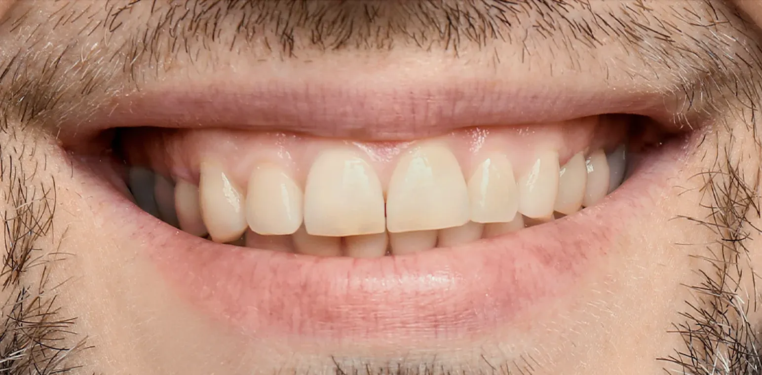 Teeth Whitening before-after7