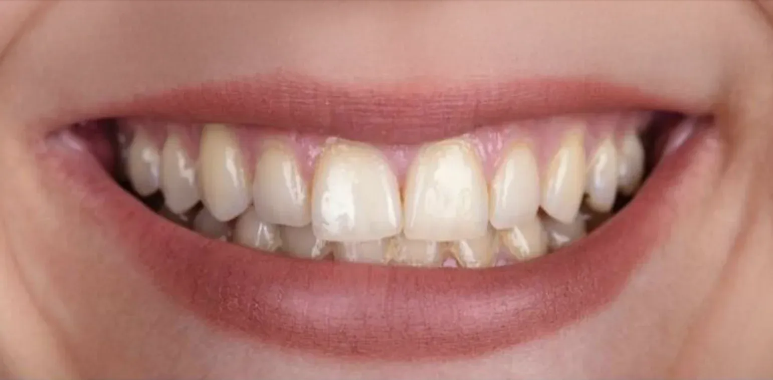 Teeth Whitening before-after9