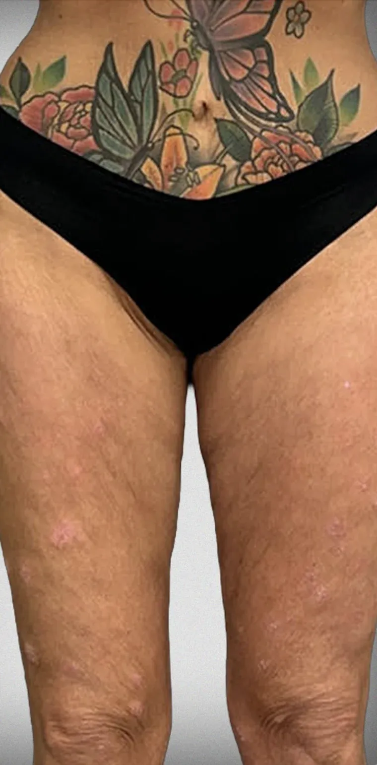 Thigh Lift2