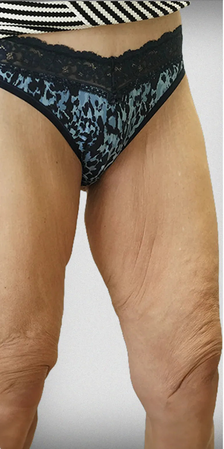 Thigh Lift3