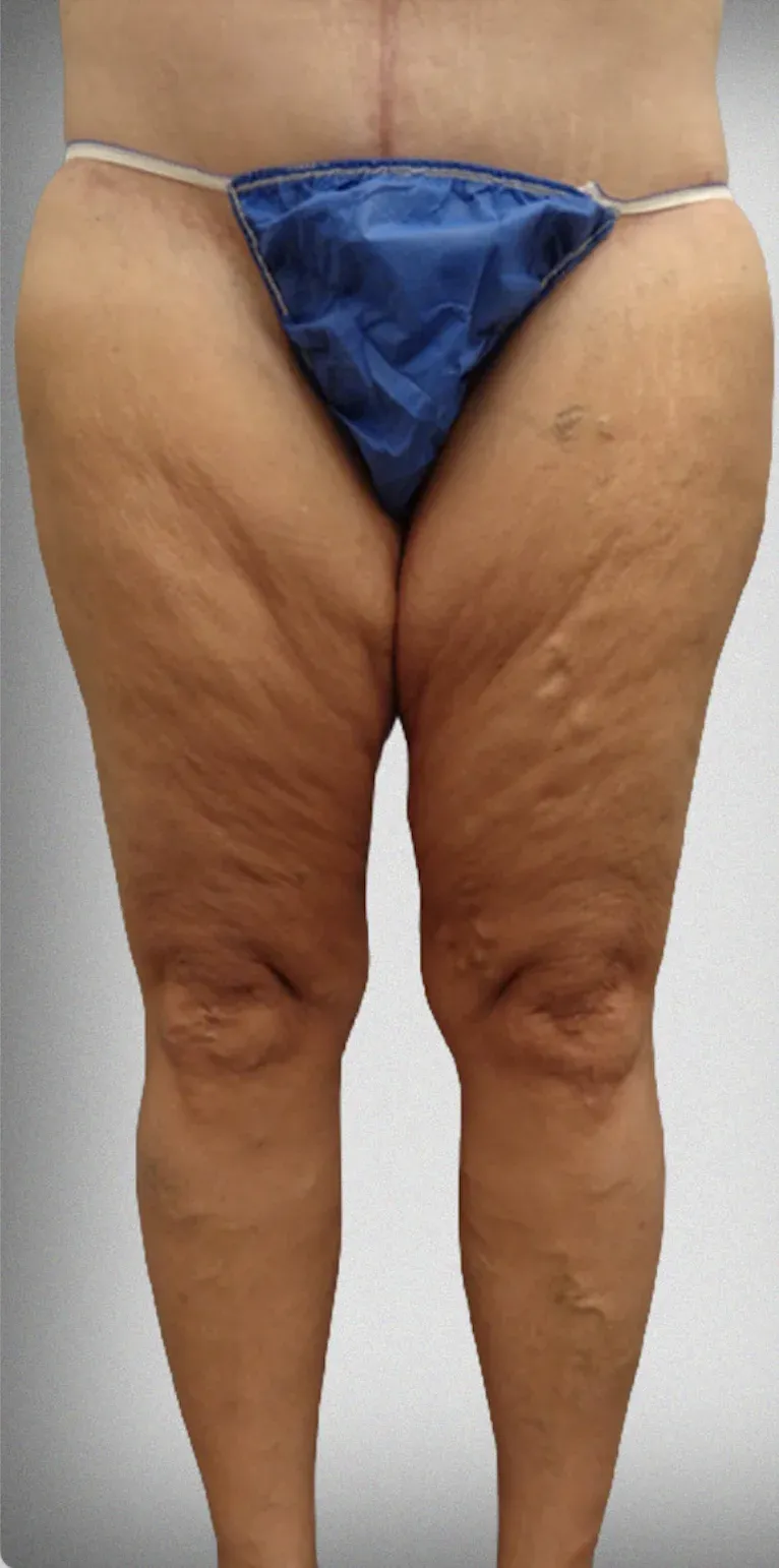 Thigh Lift7