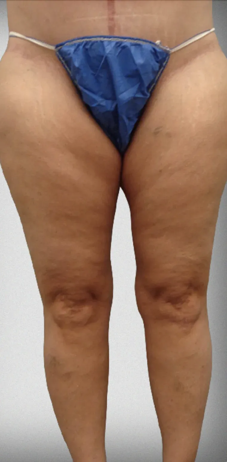 Thigh Lift8