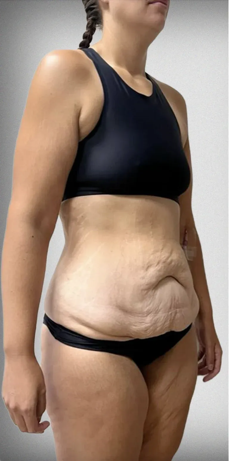 Tummy Tuck