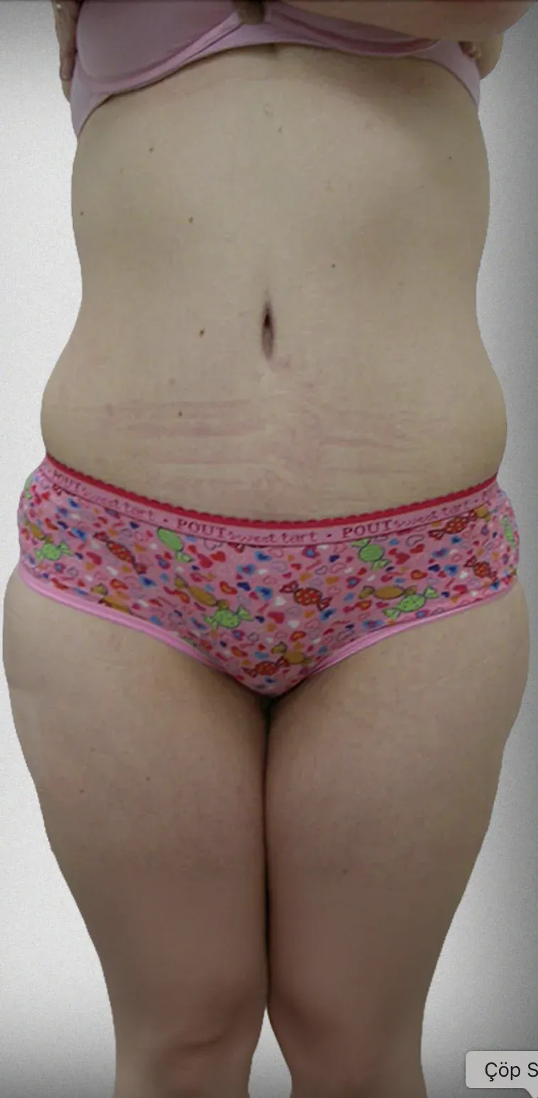 Tummy Tuck10