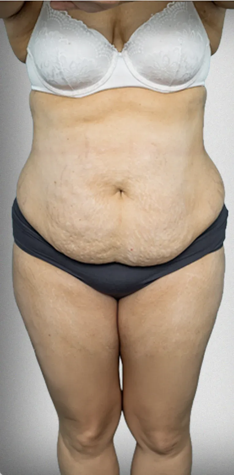 Tummy Tuck11