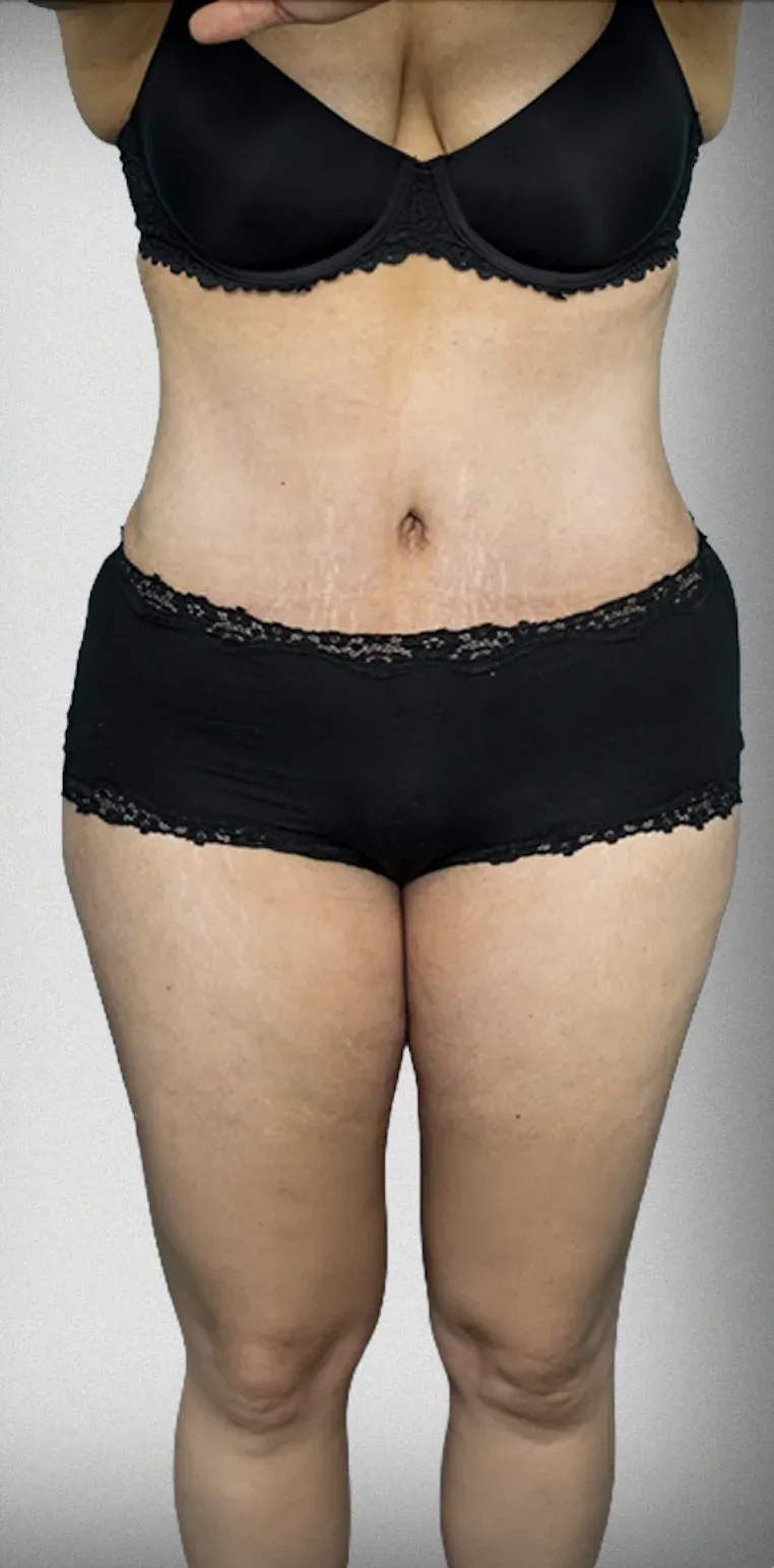 Tummy Tuck12