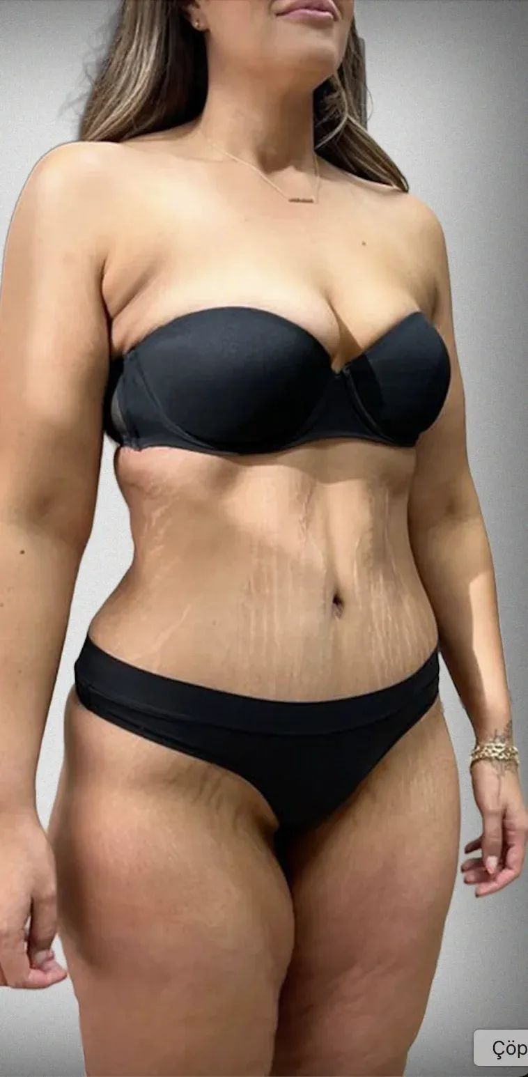 Tummy Tuck2