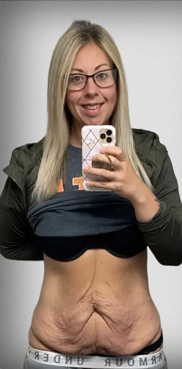 Tummy Tuck3
