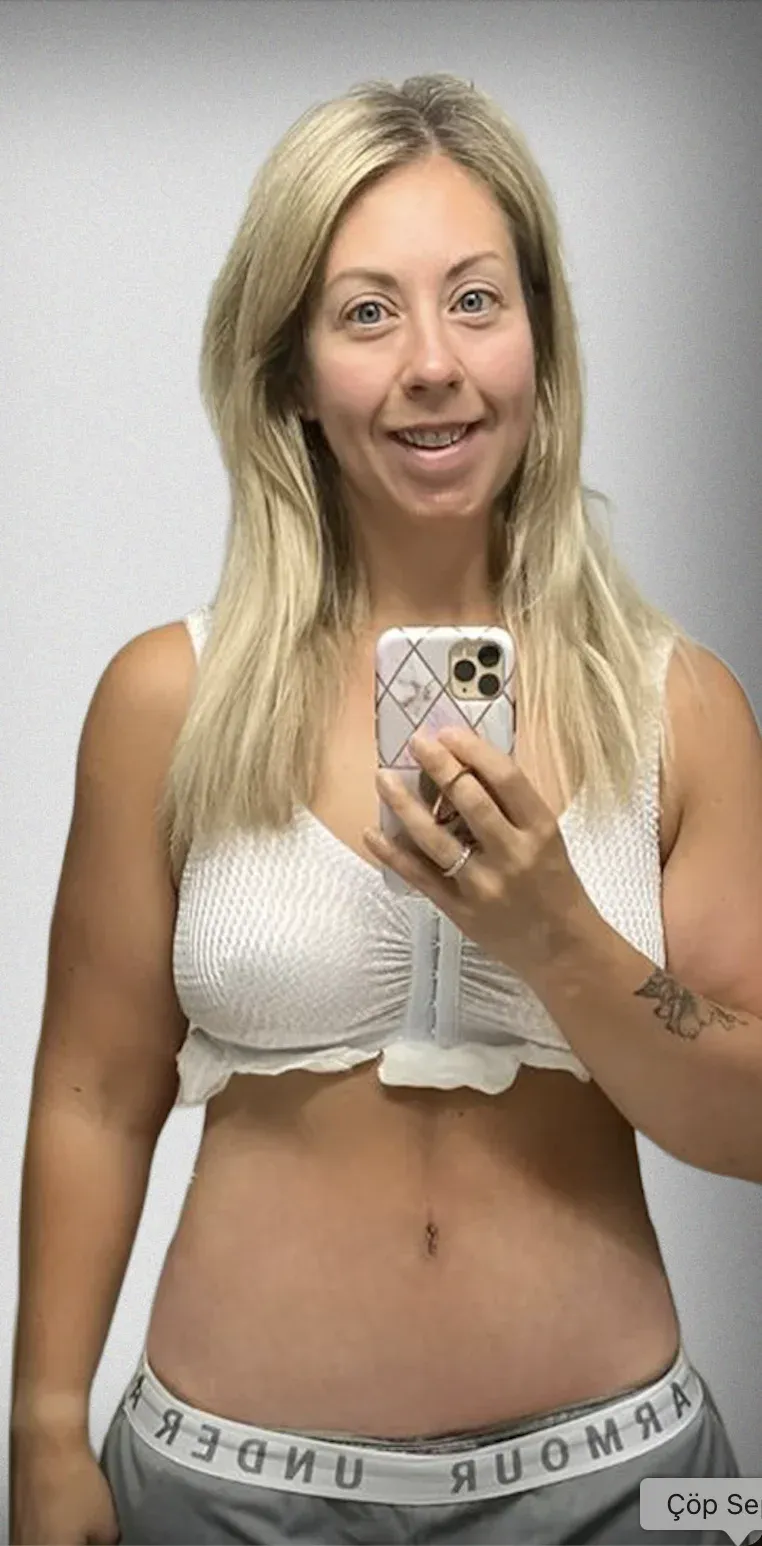 Tummy Tuck4