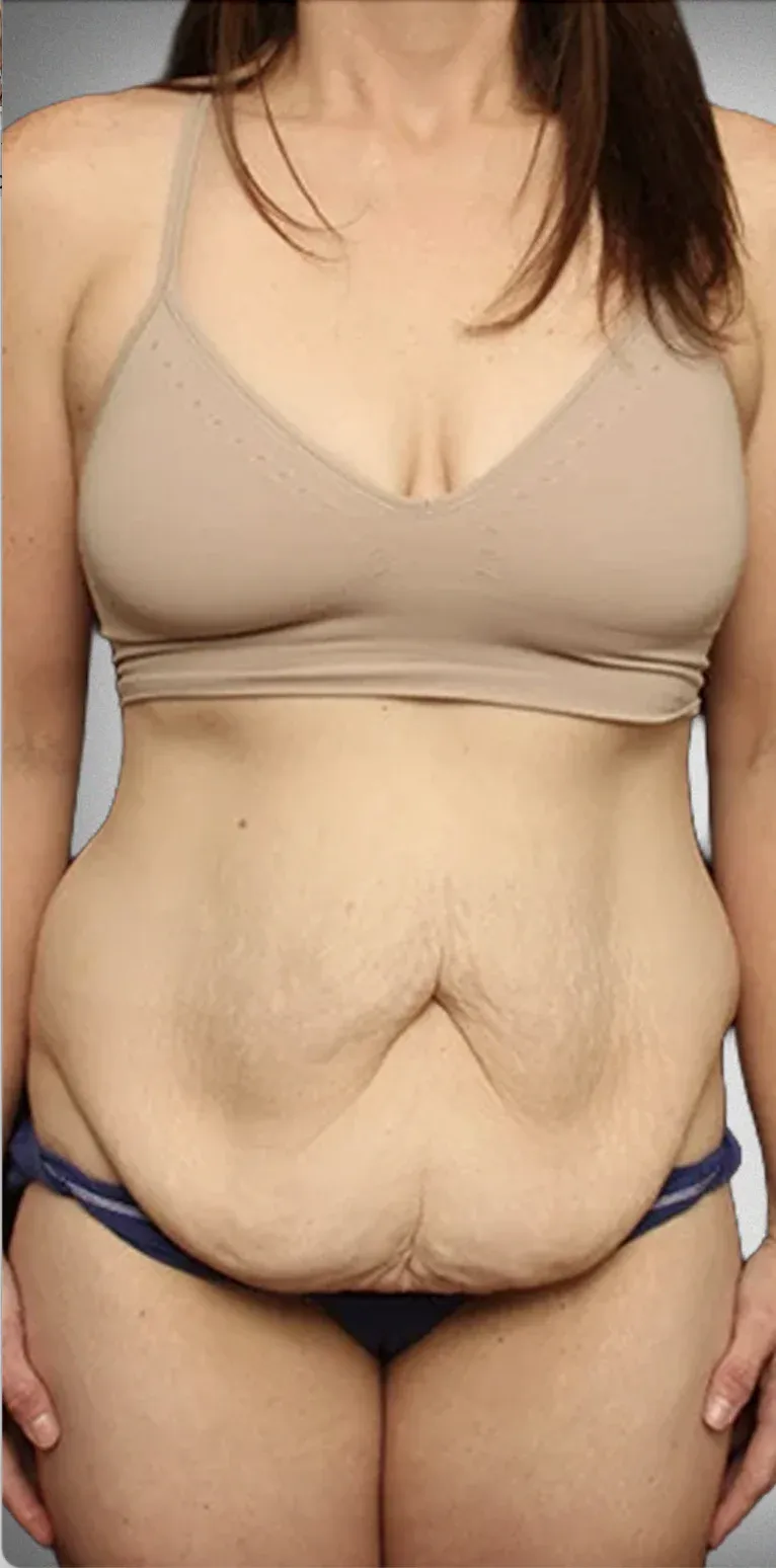 Tummy Tuck7