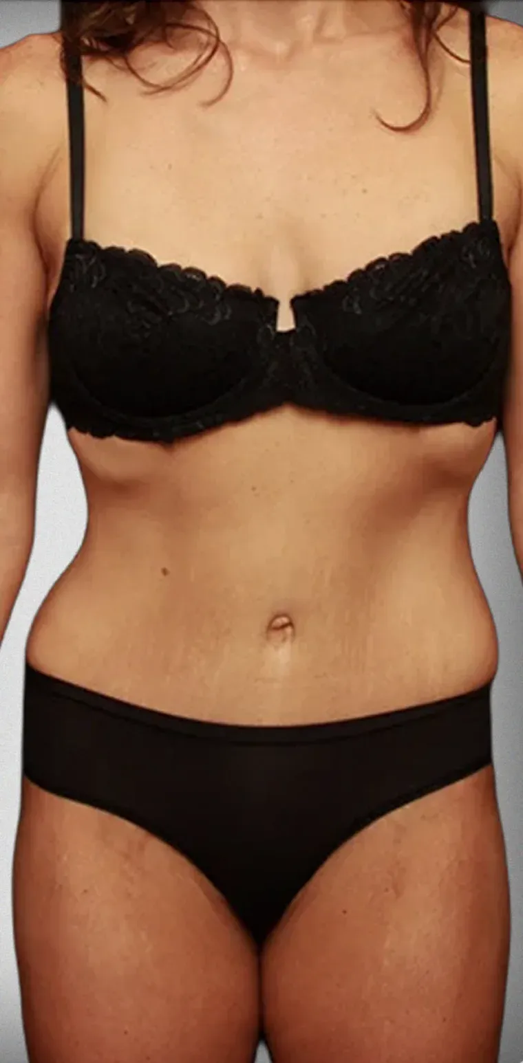 Tummy Tuck8
