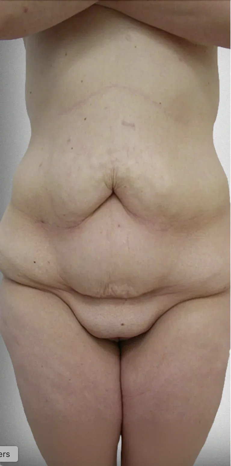 Tummy Tuck9