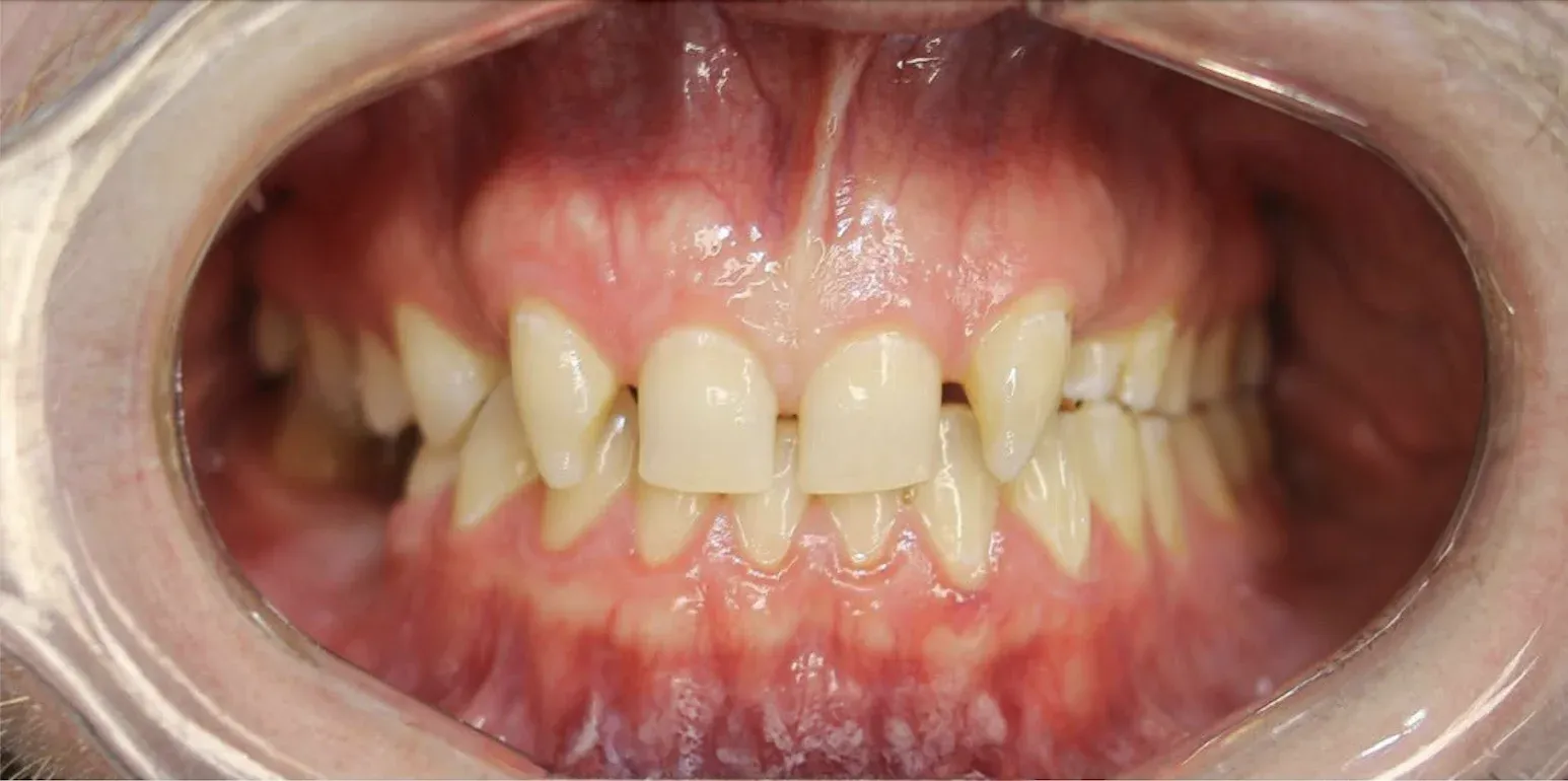 Zirconium Crowns before-after