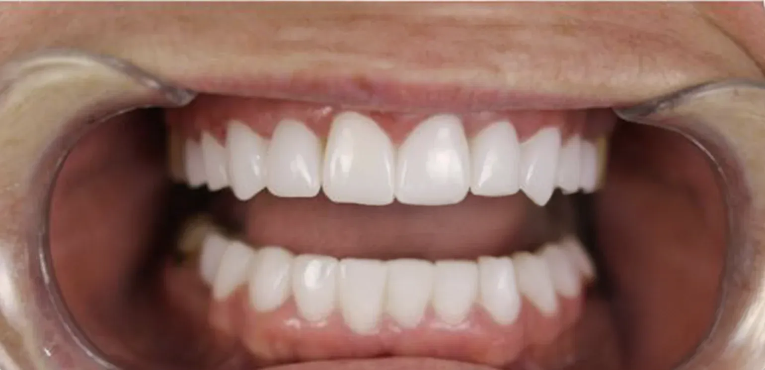 Zirconium Crowns before-after10