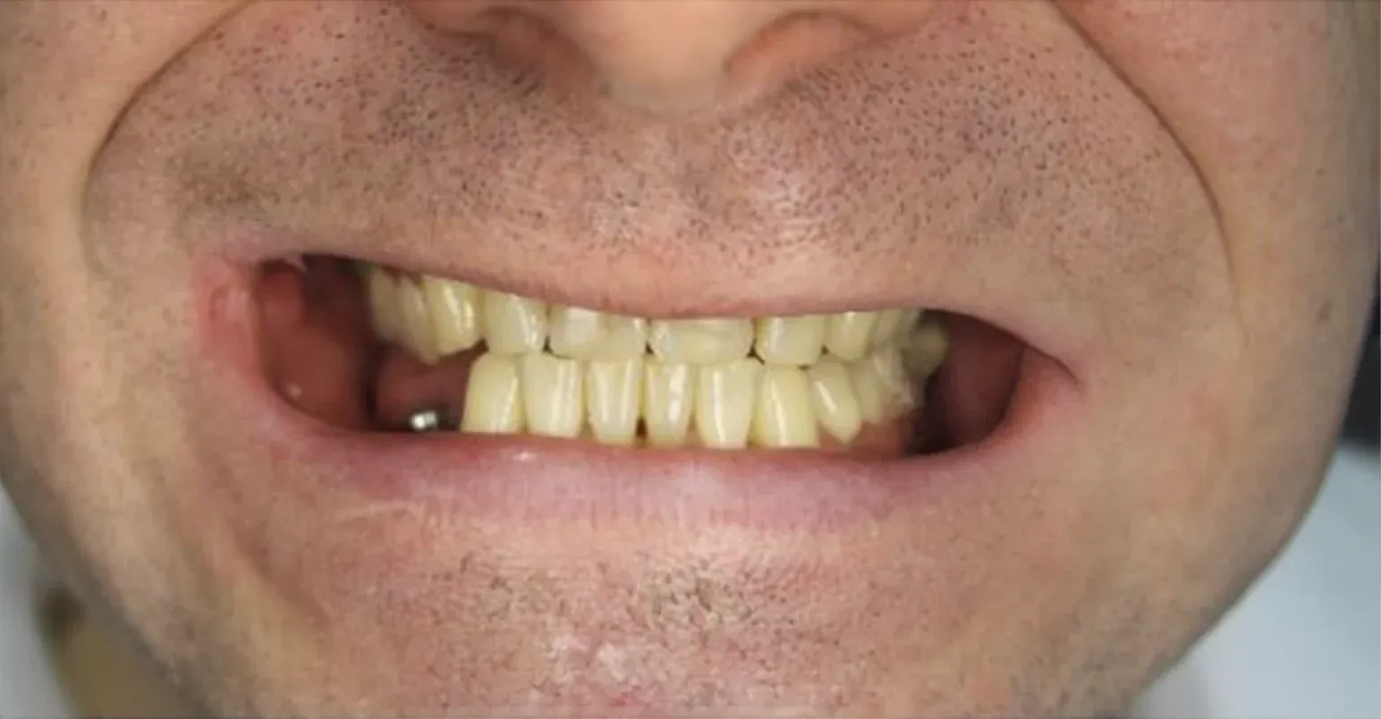 Zirconium Crowns before-after11