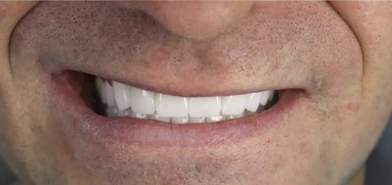 Zirconium Crowns before-after12