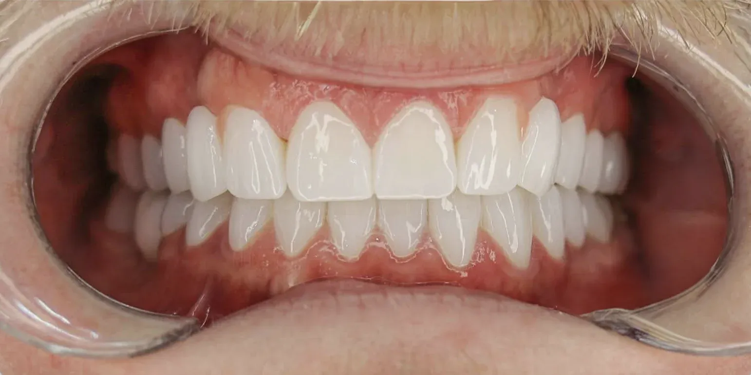 Zirconium Crowns before-after2