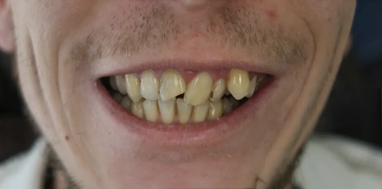 Zirconium Crowns before-after3