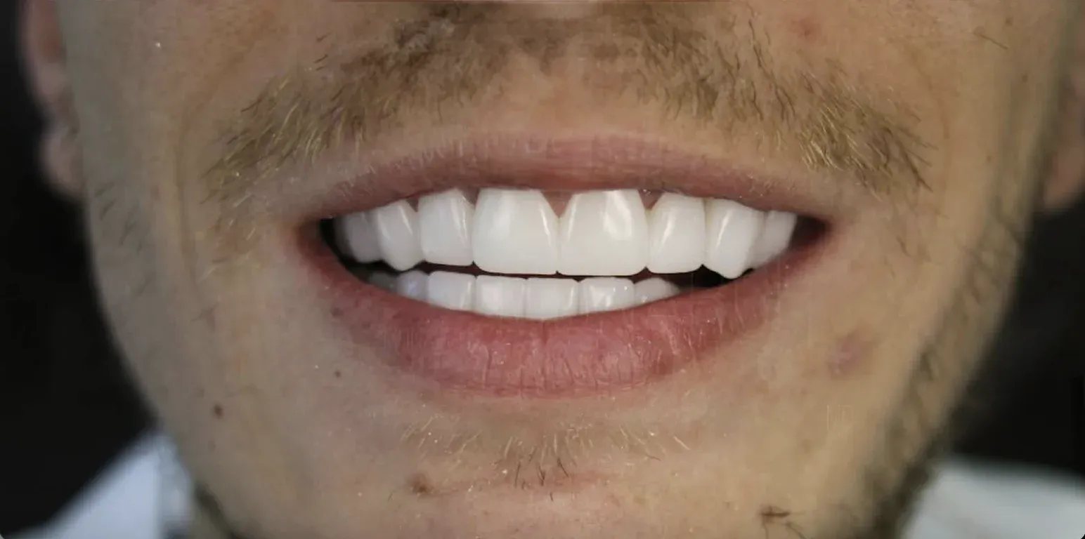 Zirconium Crowns before-after4