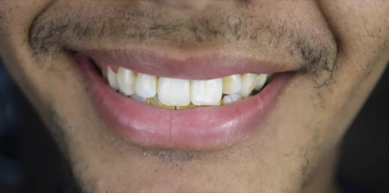 Zirconium Crowns before-after5